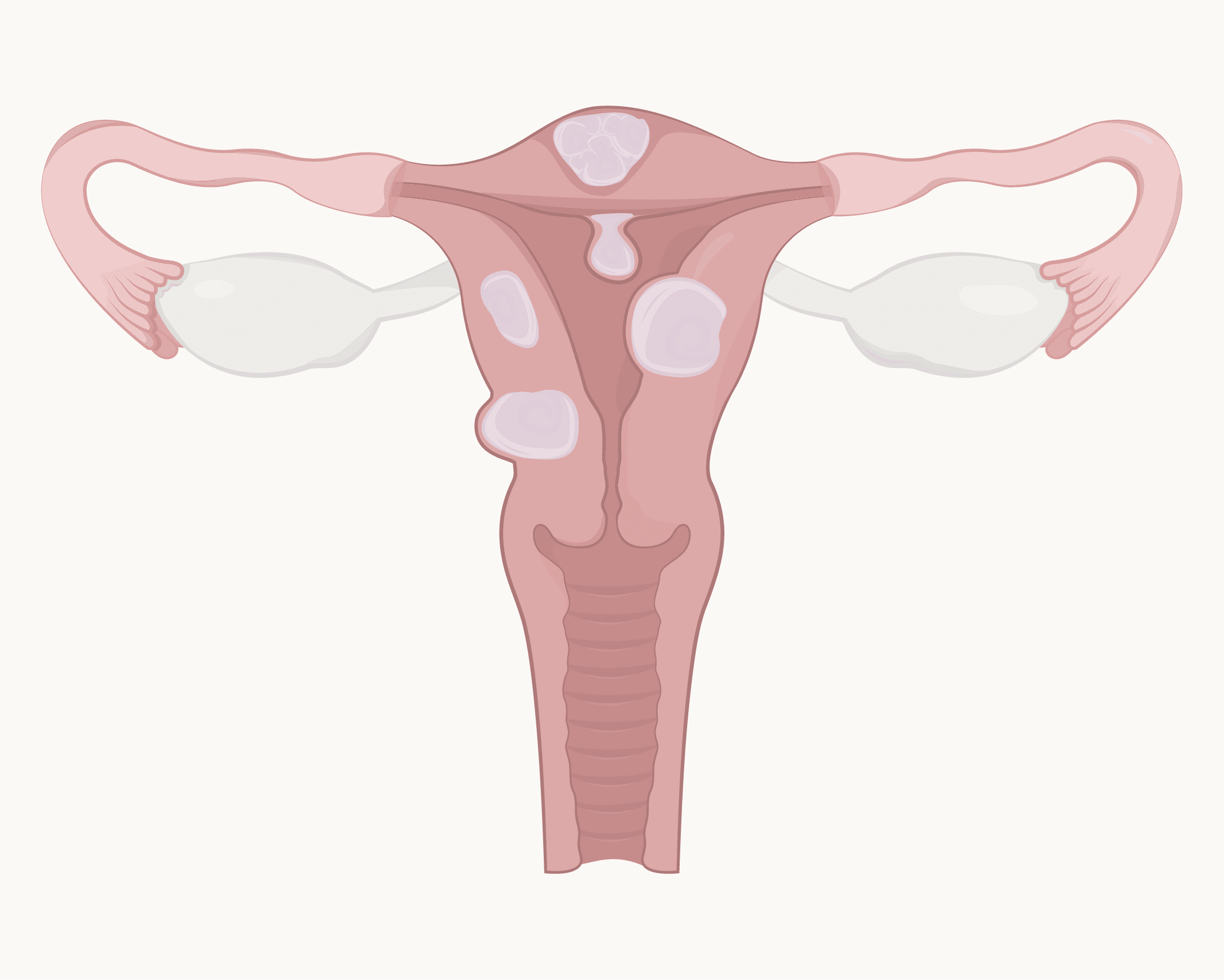 Fibroids: Everything You Need To Know