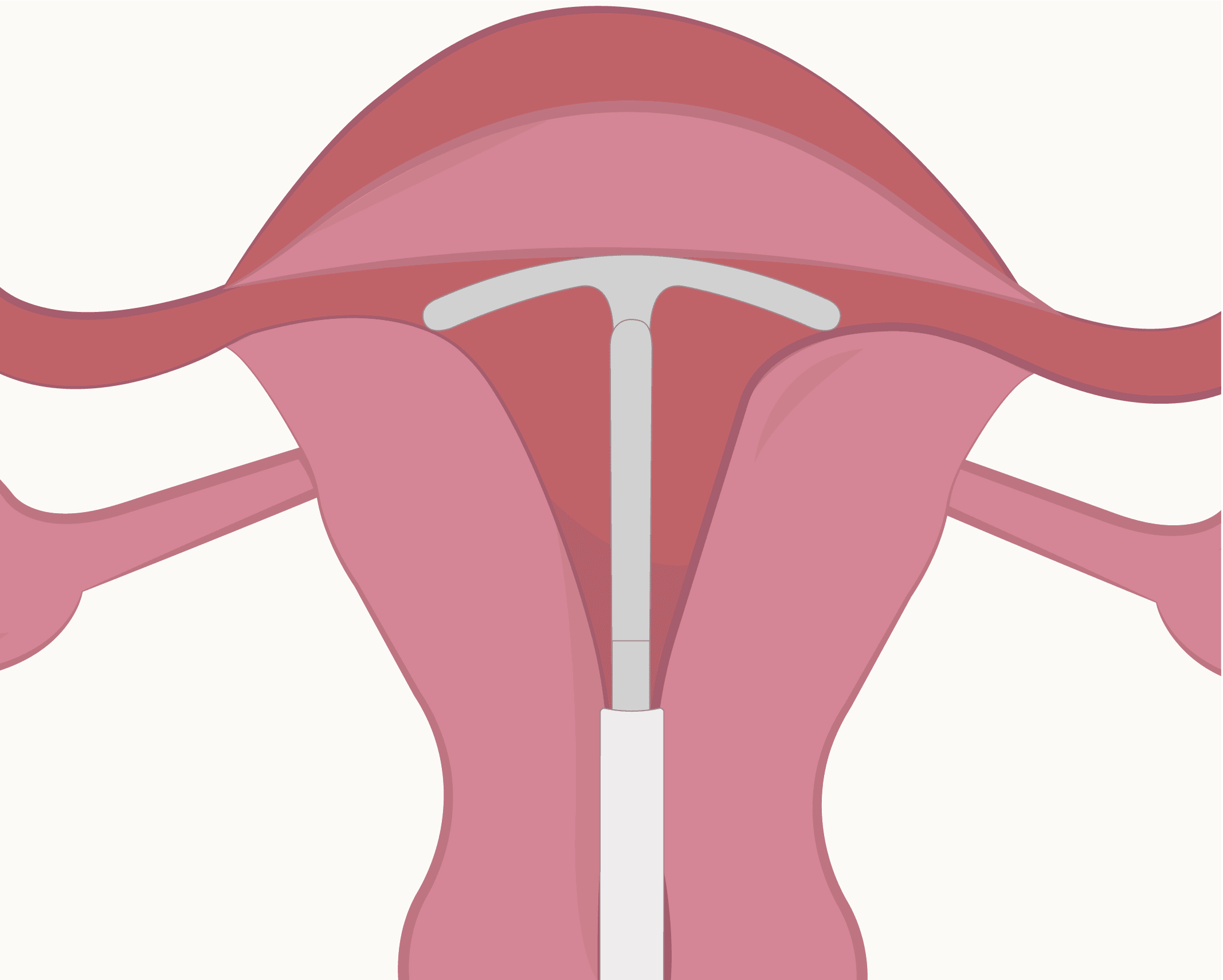 Intrauterine Device or (IUD)