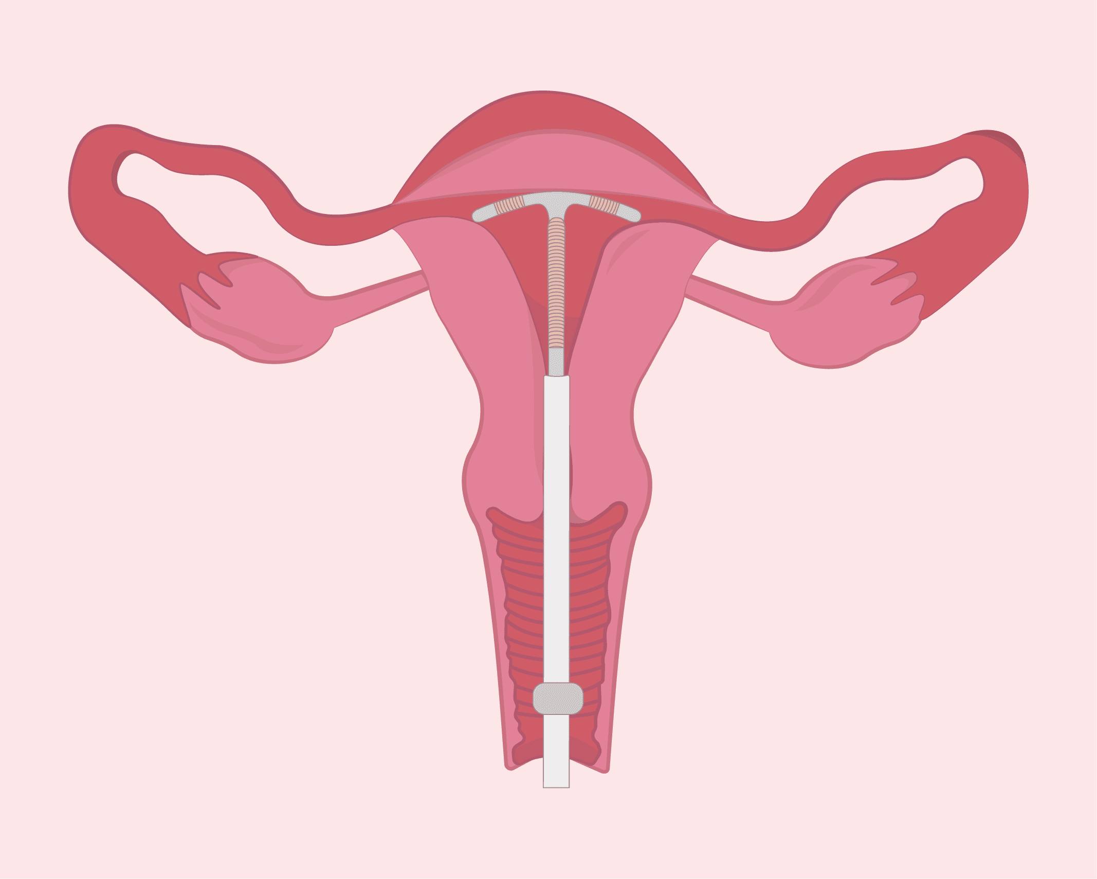 Guide to IUDs : Procedure, Symptoms, and Care