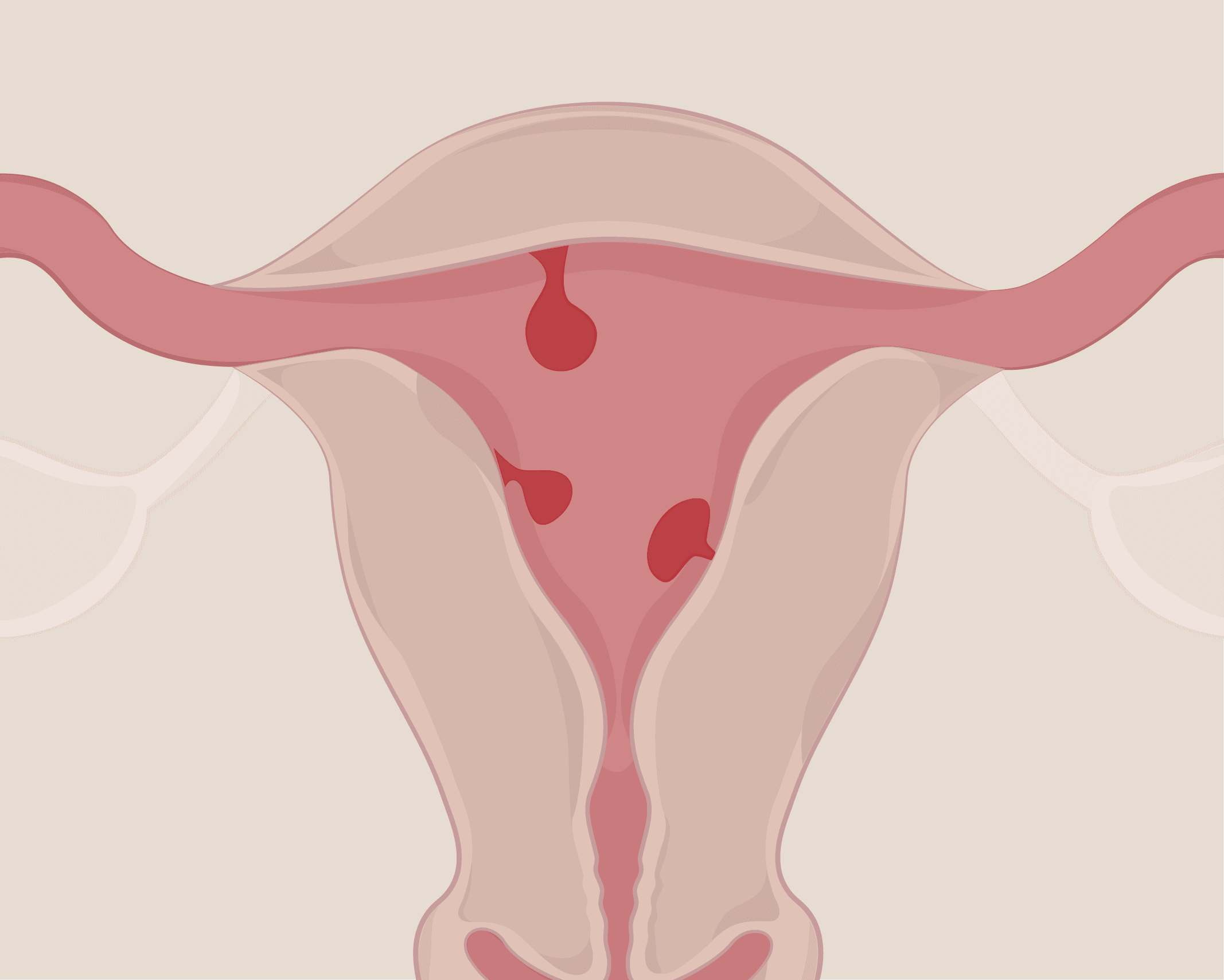 A Simple Guide To Uterine Polyps